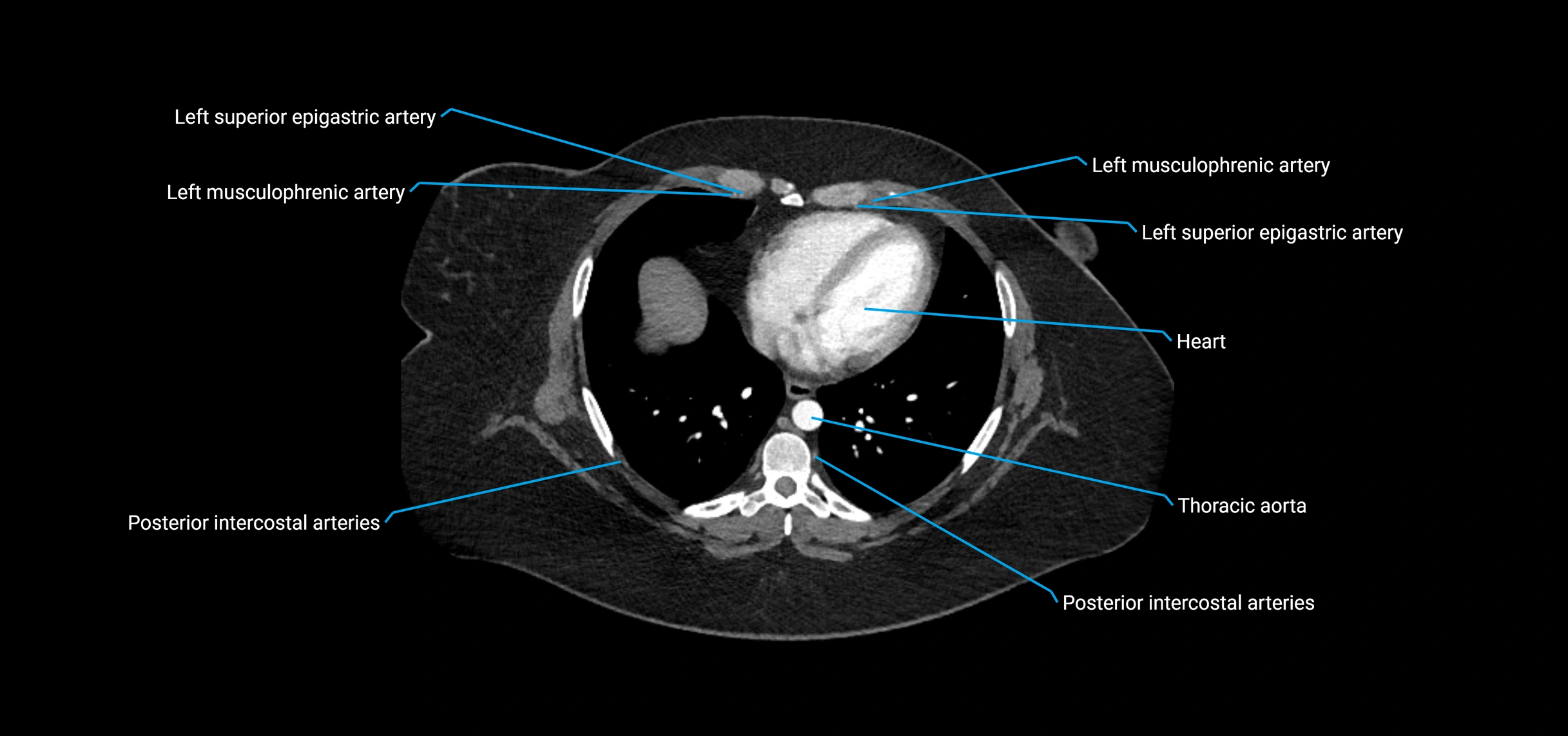 CTA abdomen axial cross sectional anatomy labelled image_5 (1).webp